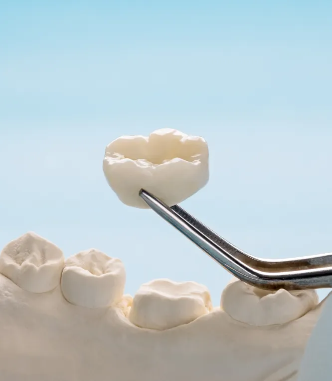 Dental Crowns at Ronald M. Adams, DMD, PC